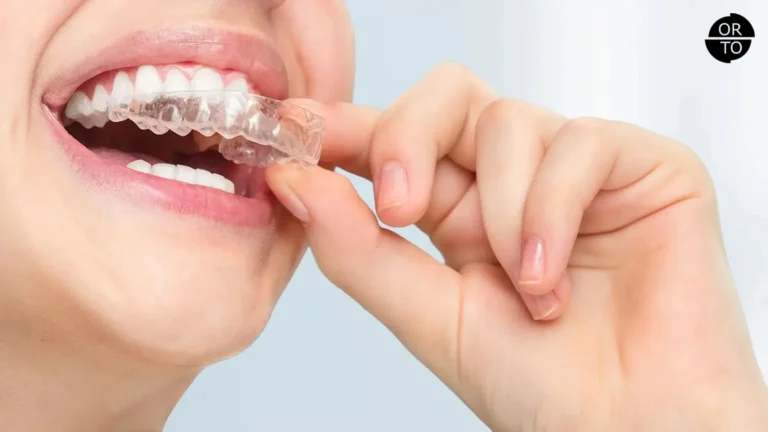 Şeffaf plak (aligner) takan bir bireyin ağız bölgesine yakın çekim