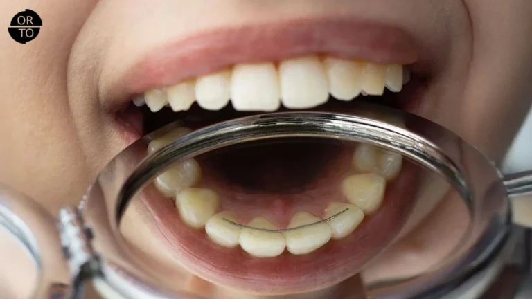 Ortodonti tedavisi sonrası alt dişlerin arkasına yerleştirilen sabit retainer (pekiştirme teli)