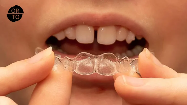 Invisalign First Nedir
