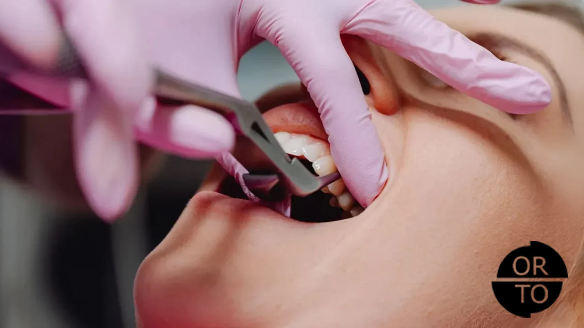 ortodonti tedavisinde diş çekilir mi
