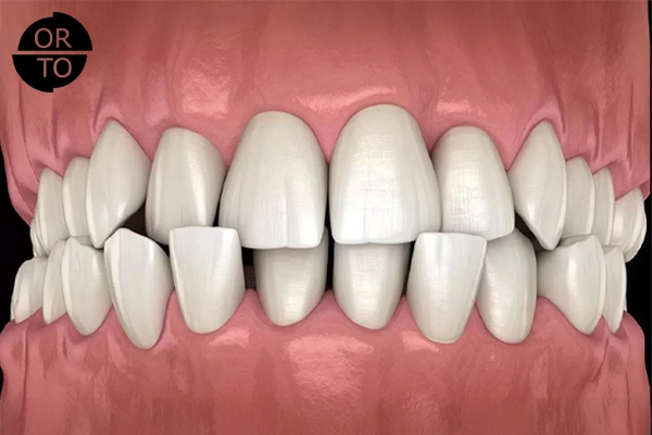 Dişlerde Çapraşıklık Neden Olur