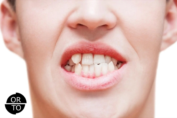 Dişlerde Çarpıklık Neden Olur