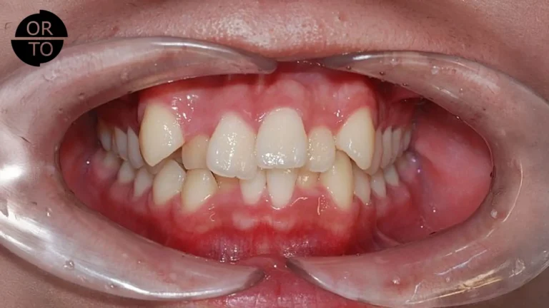 dişlerde-çapraşıklık-neden-olur