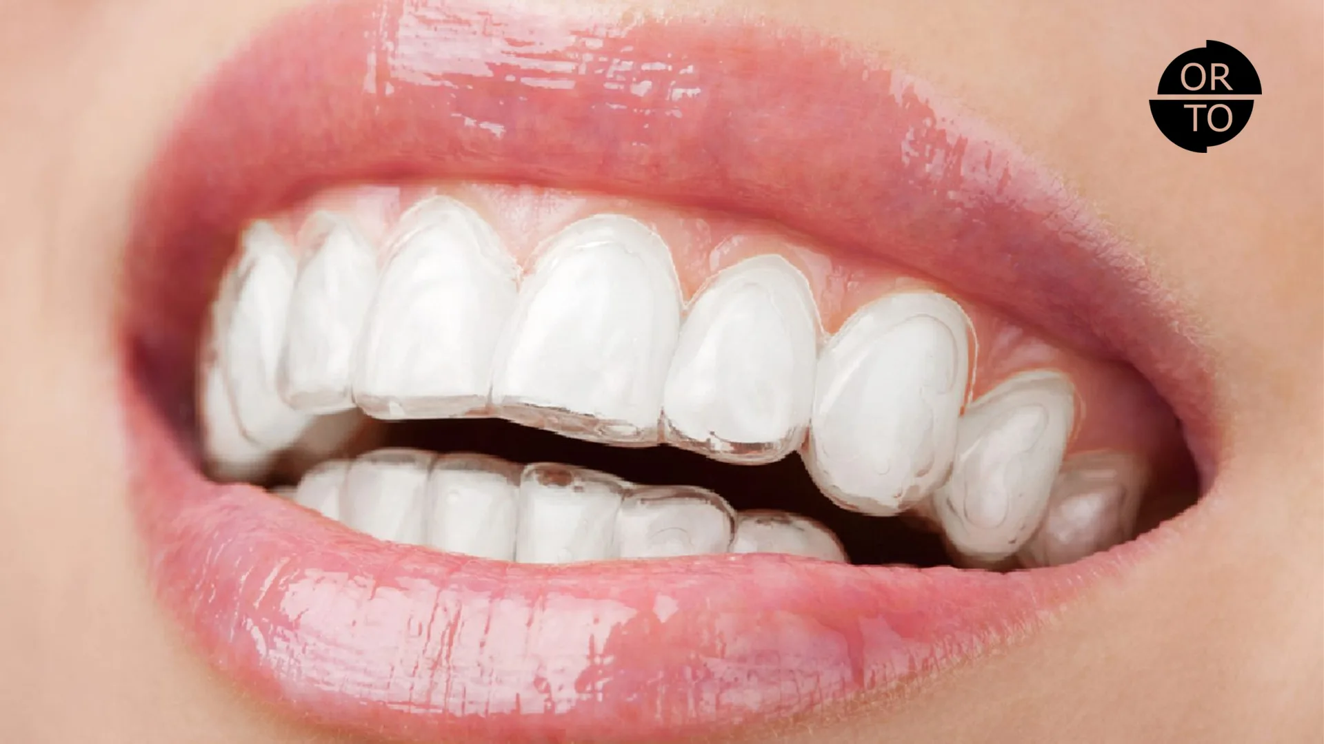 Invisalign-Kullanırken-Nelere-Dikkat-Etmeliyiz