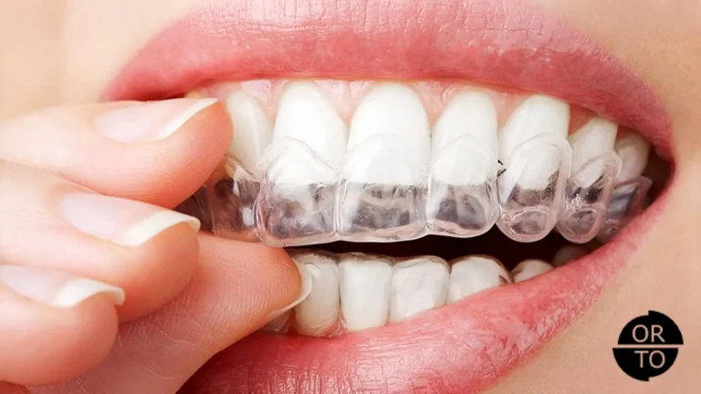 Ortodonti-Tedavisi-Sırasında-Dişler-Nasıl-Hareket-Eder