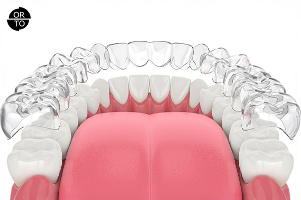 Invisalign tedavisi