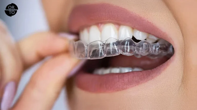Telsiz Ortodonti (Invisalign)