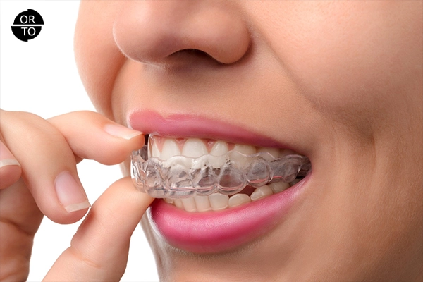 Bir kişinin şeffaf diş plağını (aligner) üst dişlerine yerleştirmesi