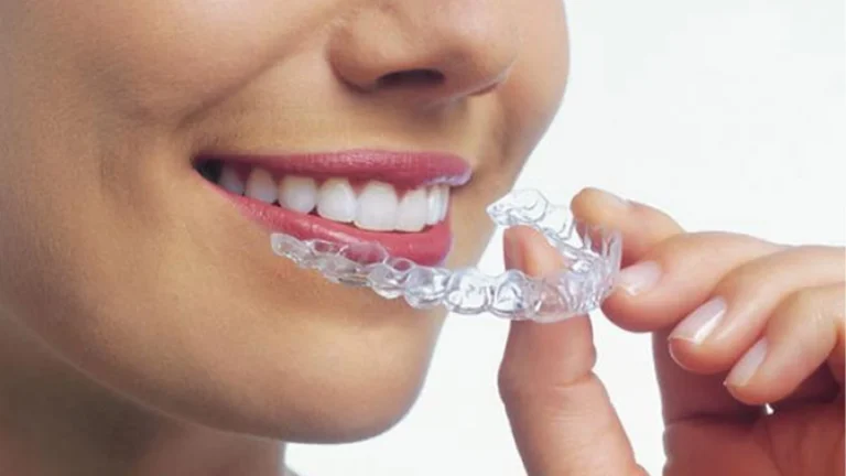 Aligner-mı-Invisalign-mı-Şeffaf-Aparey-mi-Şeffaf-Plak-mı
