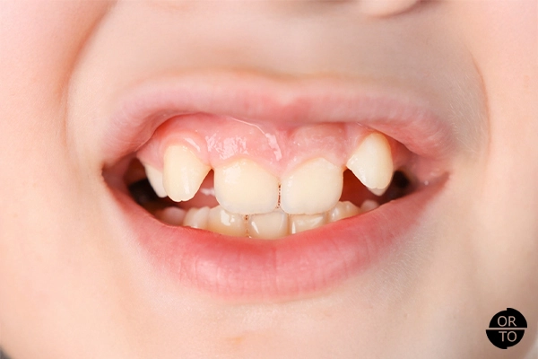 Maloklüzyon ve diş dizilimi bozukluğuna sahip bir çocuğun ağzı