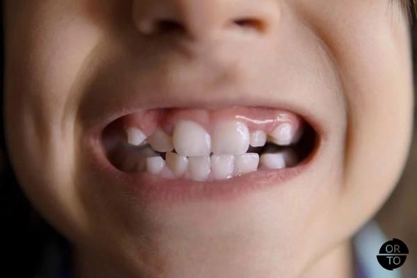 Maloklüzyonun tipik bir belirtisi olan diş çapraşıklığı ve alt-üst dişler arasında uyumsuz kapanışa sahip bir çocuk