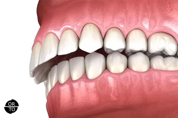 Üst çene geriliğini (maksiller retrognati) gösteren diş kapanışı