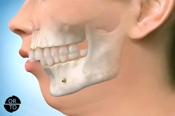 Alt çene geriliğini (mandibular retrognati) gösteren anatomik görsel