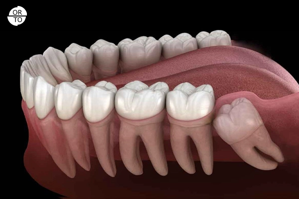 Alt çenede yatay şekilde gömülü kalan 20’lik dişin komşu dişe baskı yaptığı 3D diş modeli