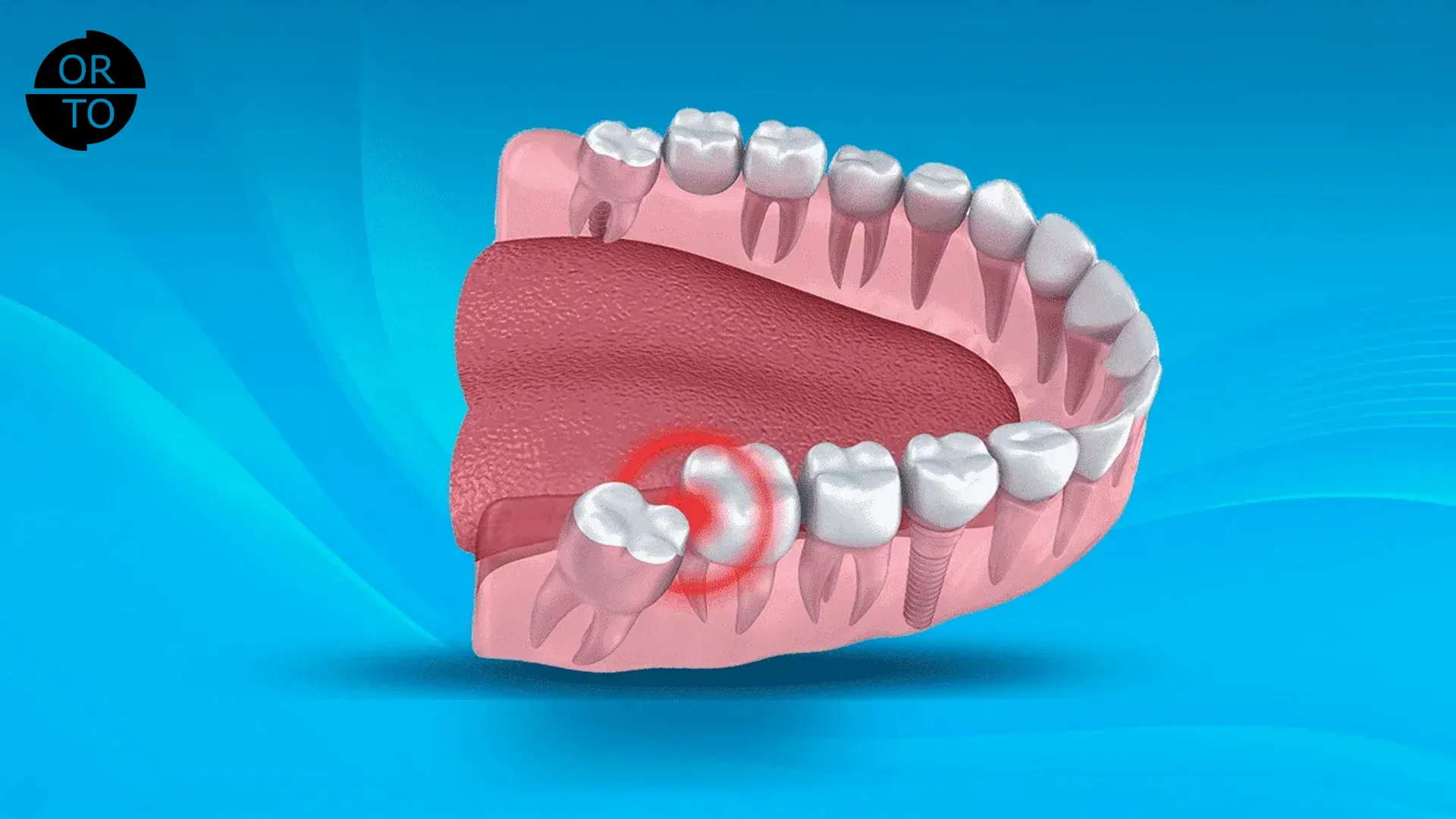 Gömülü 20’lik dişin diğer dişe baskı yaptığı çene yapısını gösteren 3D diş anatomisi